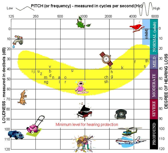 Audiogramme schématique. Tout est audiodécrit dans mon post. Audiogramme schématique. Tout est audiodécrit dans mon post.